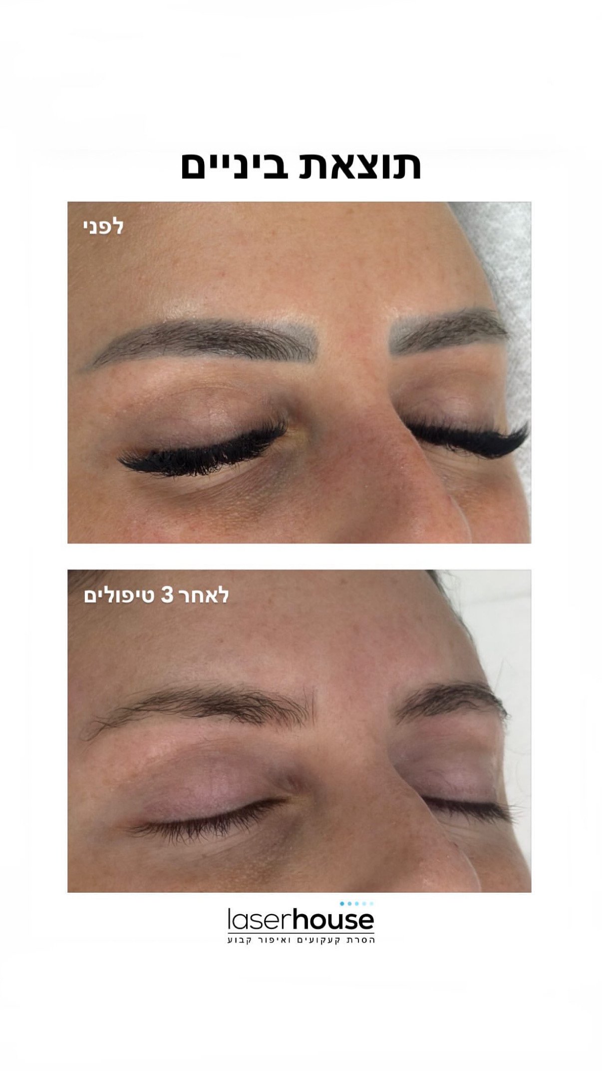 הסרת איפור קבוע בגבות