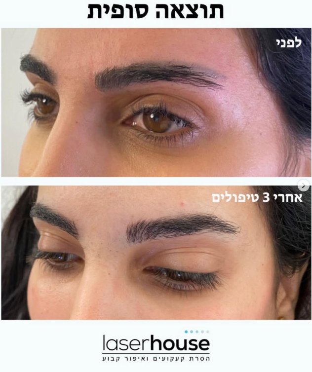 הסרת איפור קבוע בגבות